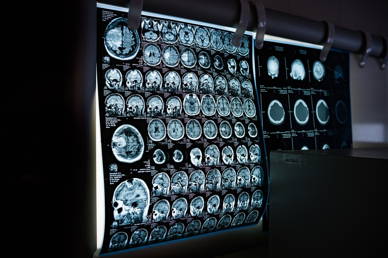 MRI images of a skull and brain